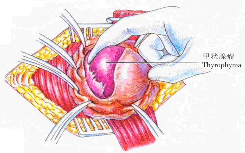 甲状腺瘤的表现