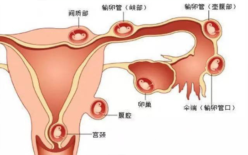 宫外孕胎儿位置图