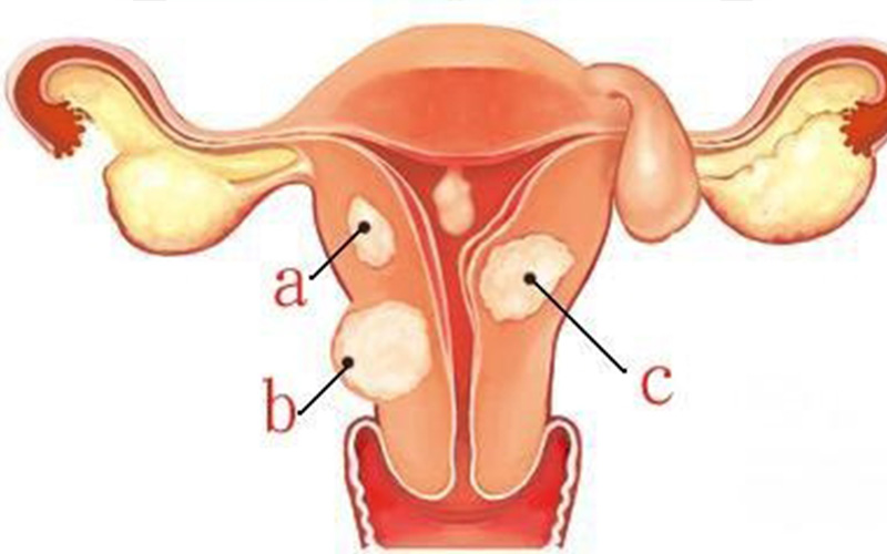 子宫肌瘤位置图