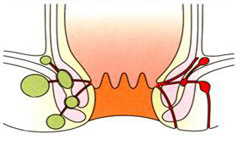 男性肛门疣图片