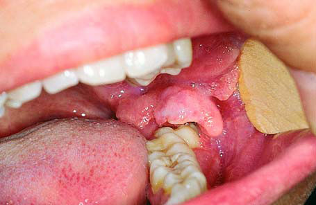 3,智齿冠周炎:青壮年患者多见,下颌或上颌牙龈最里面那里肿痛,张口