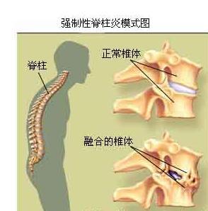 强直性脊柱炎系统化治疗方案