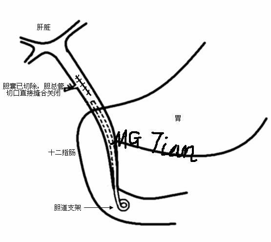 胆囊结石合并胆总管结石的最佳微创治疗(图示)