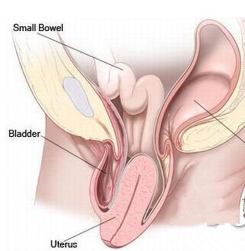子宮脫垂會導(dǎo)致病變的圖片