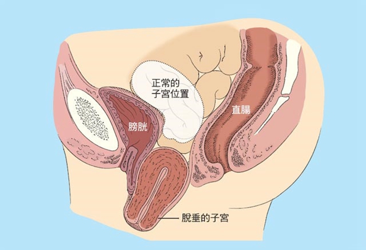 子宮脫垂與正常子宮位置圖片