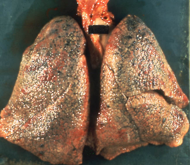 正常肺部与肺纤维化x线对比图片