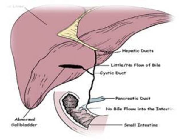胆道闭锁如何治疗?