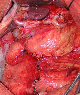 胃肠癌手术图片展示