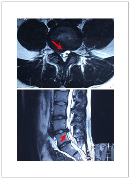 图2,腰椎核磁共振提示l4-5椎间盘突出,红色箭头提示神经根受到明显