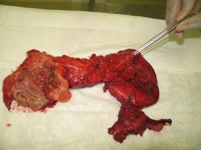 直肠息肉的早期症状图片