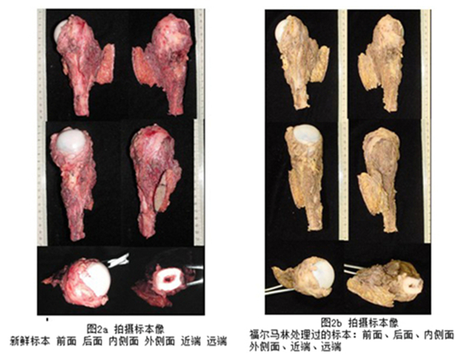 恶性骨肿瘤标本图片