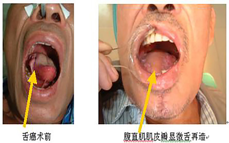 舌癌手術(shù)前后對比圖片