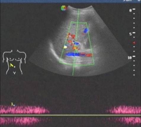 联合疗法治疗晚期肝癌效果好