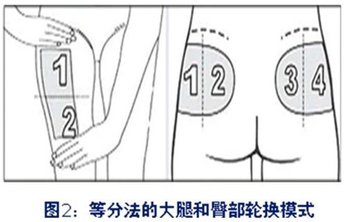 第89期:胰岛素注射部位的轮换