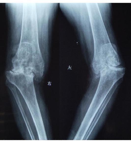 x片显示双侧膝关节严重损毁,半脱位