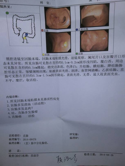 直肠癌的肠镜报告图片