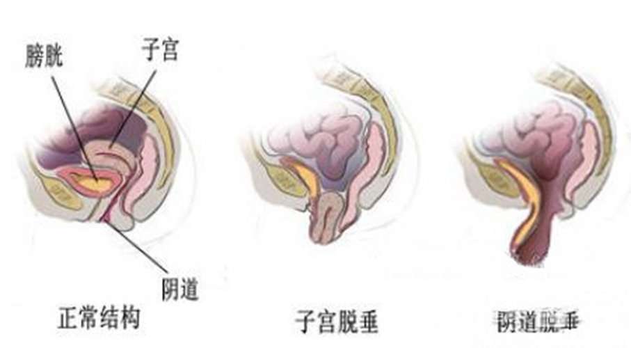 片子宮脫垂應(yīng)該注意事項圖片