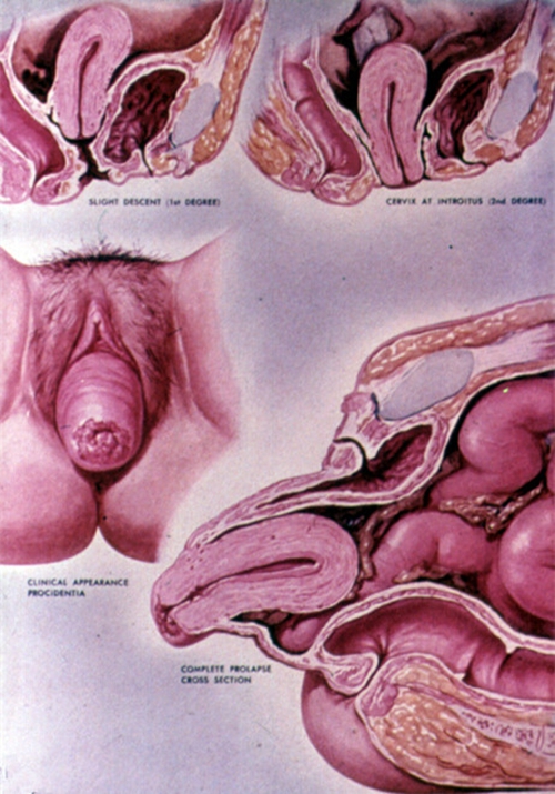 女人子宮脫垂圖片