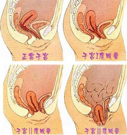 子宮脫垂不同癥狀的圖片