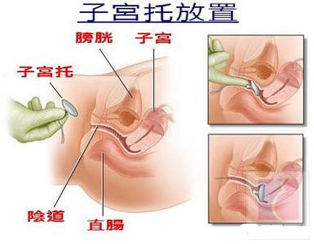 子宮脫垂放子宮托位置圖片