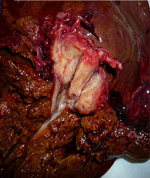 肝门胆管癌晚期症状图片