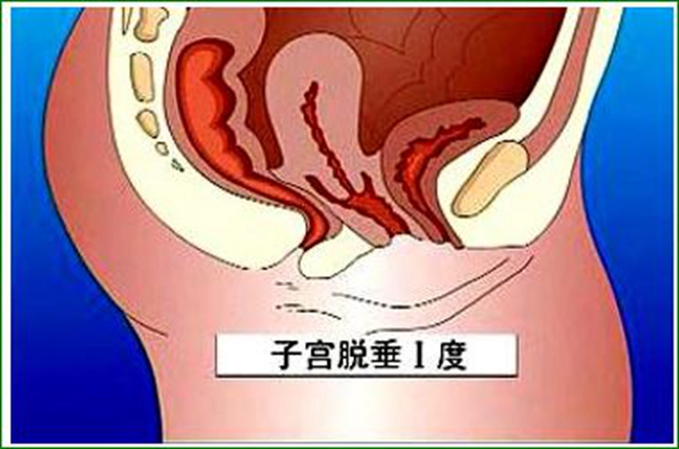 子宮脫垂圖片