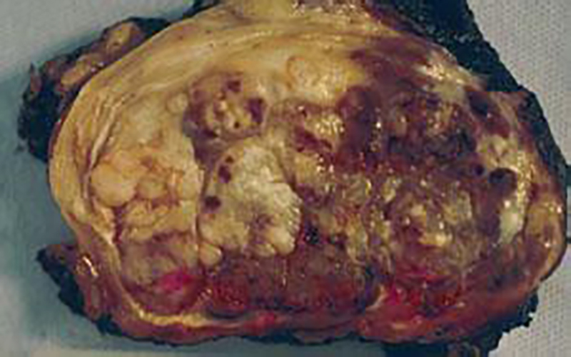 滑膜肉瘤