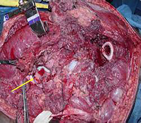 早期滑膜肉瘤症状图片