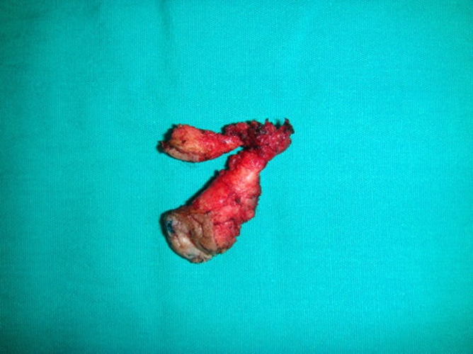 解剖学肛瘘切除术的图片