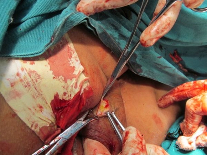 瘘性肛周脓肿手术图片