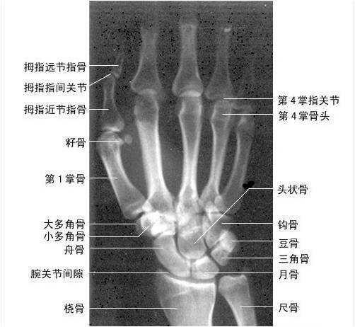 骨周围脱位为腕部常见脱位,腕关节结构复杂,月骨为腕关节8块腕骨之一