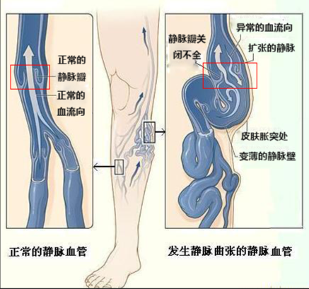 另外,对于下肢静脉曲张特别严重,怀疑深静脉瓣膜功能不全的患者