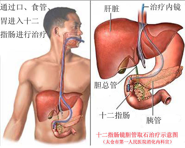 ercp如何胆管取石?(图解说明)