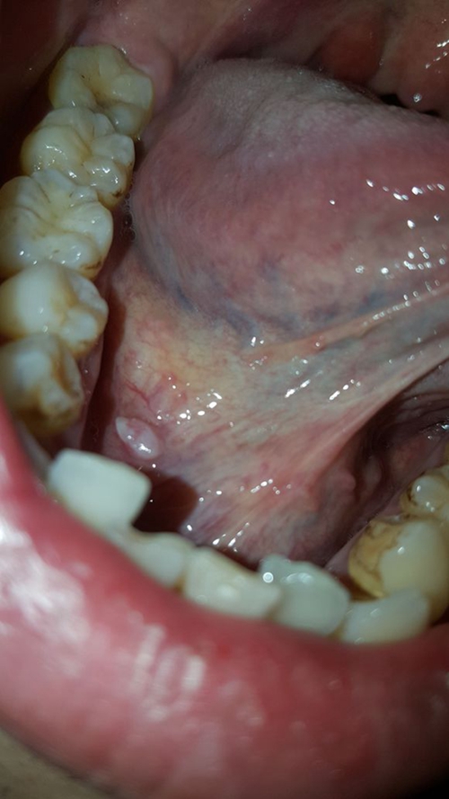 舌下腺囊肿介绍_舌下腺囊肿病因_舌下腺囊肿治疗_囊肿