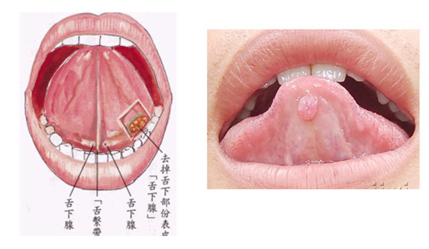  舌下腺囊腫發(fā)生癌變圖片