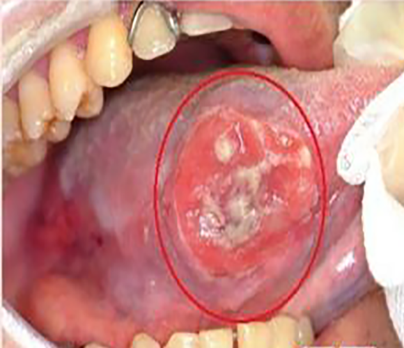 舌癌口腔溃疡图片