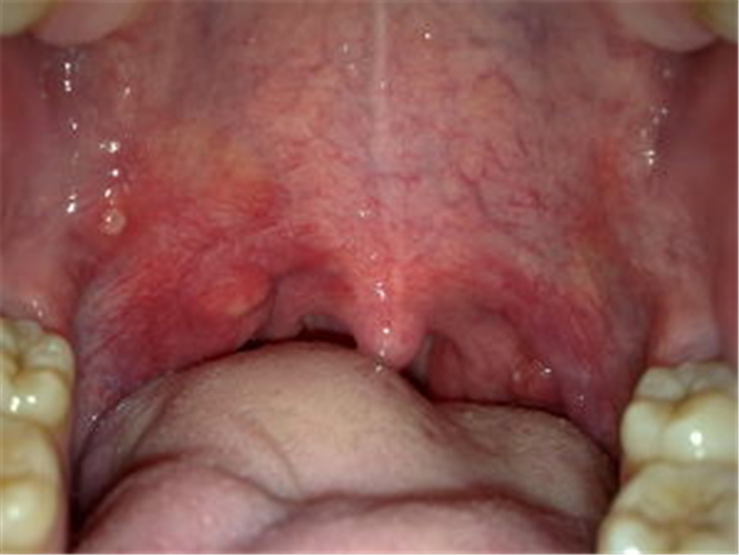 急性鼻咽炎咽喉部图片