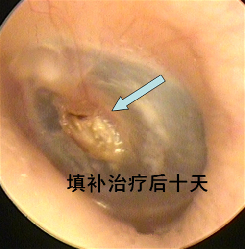 鼓膜穿孔填補治療圖片