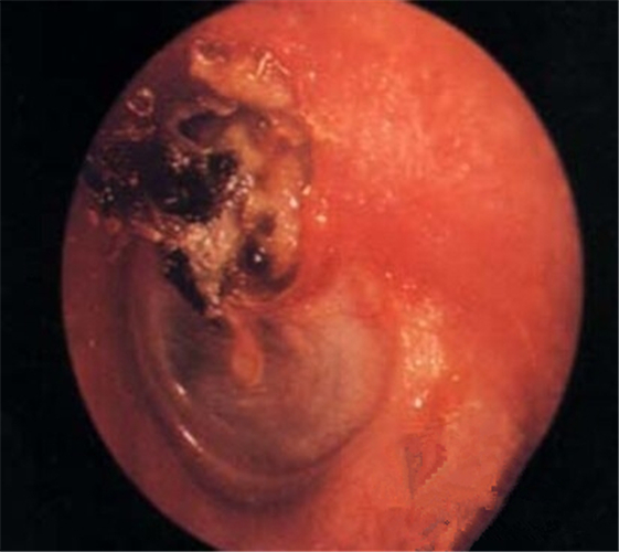 炎癥導(dǎo)致的鼓膜穿孔圖片