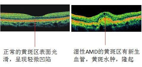 六步检查让老年黄斑变性无所遁形.