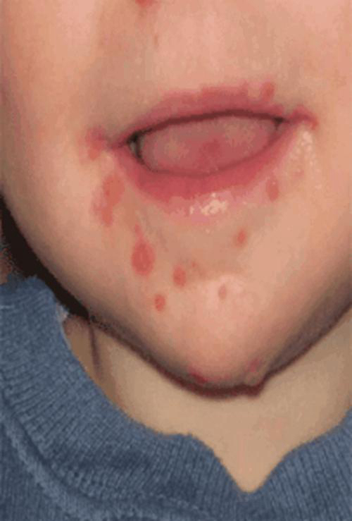 儿童单纯性疱疹溃疡图片