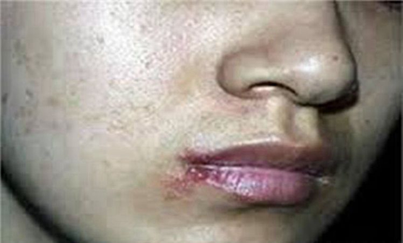 口唇疱疹初期图片