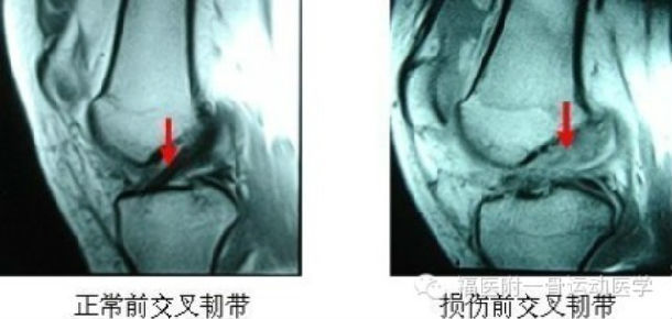 前交叉韧带损伤是怎么回事儿?