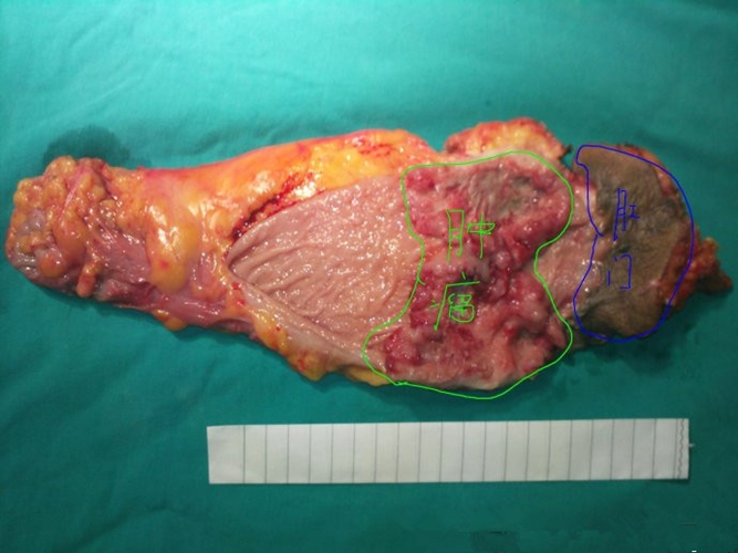 直肠癌手术 的图片