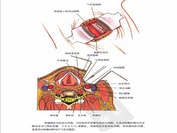 颈椎手术没那么可怕!-图解手术过程
