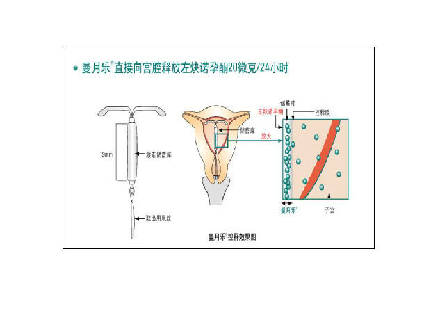 曼月乐――治疗子宫腺肌症的宫内节育器