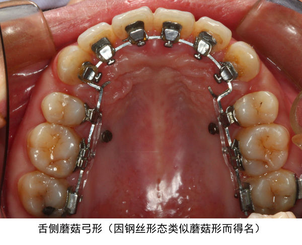 舌侧直丝弓矫正技术是什么?