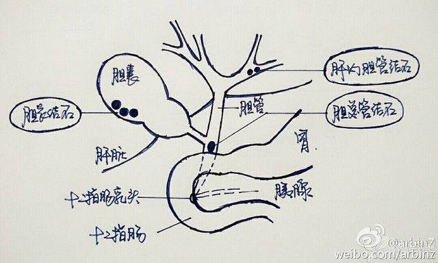 6,胆管结石和胆囊结石有什么区别?