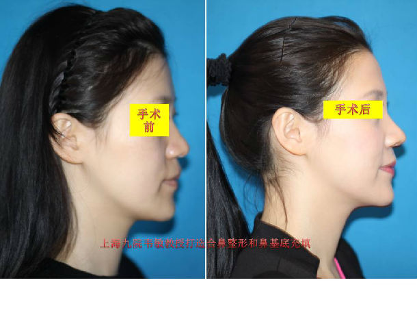 综合隆鼻整形,鼻基底充填,手术前后照片对比