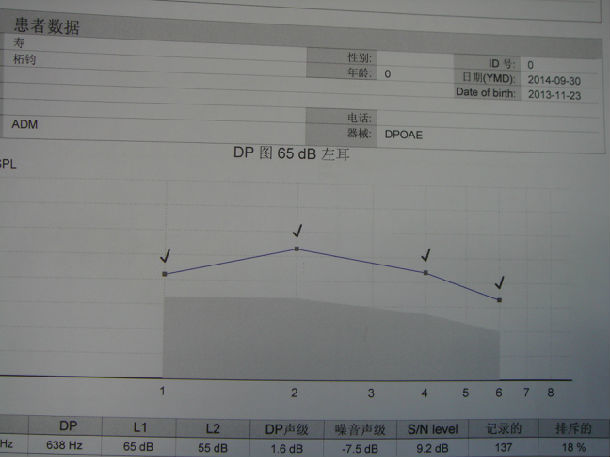 85db,,声导抗测试示双耳鼓室曲线为a型,镫骨肌反射未引出